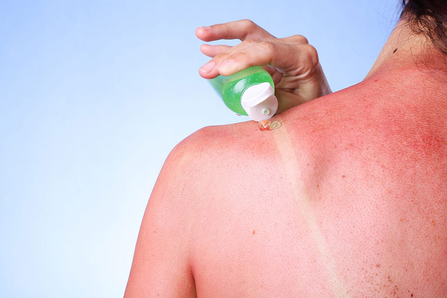 برای جلوگیری از آفتاب سوختگی چه کار باید کرد