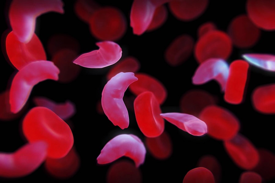 19 ژوئن ، روز جهانی آگاهی از کم خونی داسی شکل