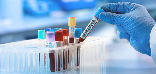 شناسایی گروه های خونی نادر با آزمایش