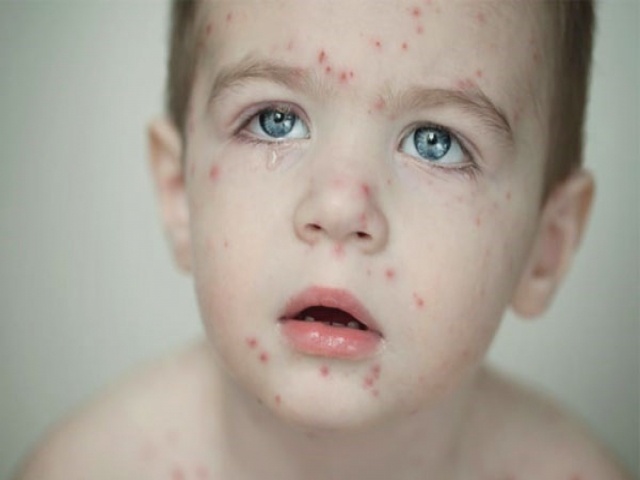 هشدار وزارت بهداشت در خصوص شیوع سرخک هشدار وزارت بهداشت در خصوص شیوع سرخک