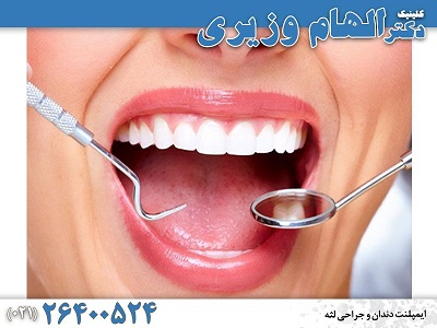 انواع ایمپلنت دندان به همراه مراحل و قیمت در سال 1401