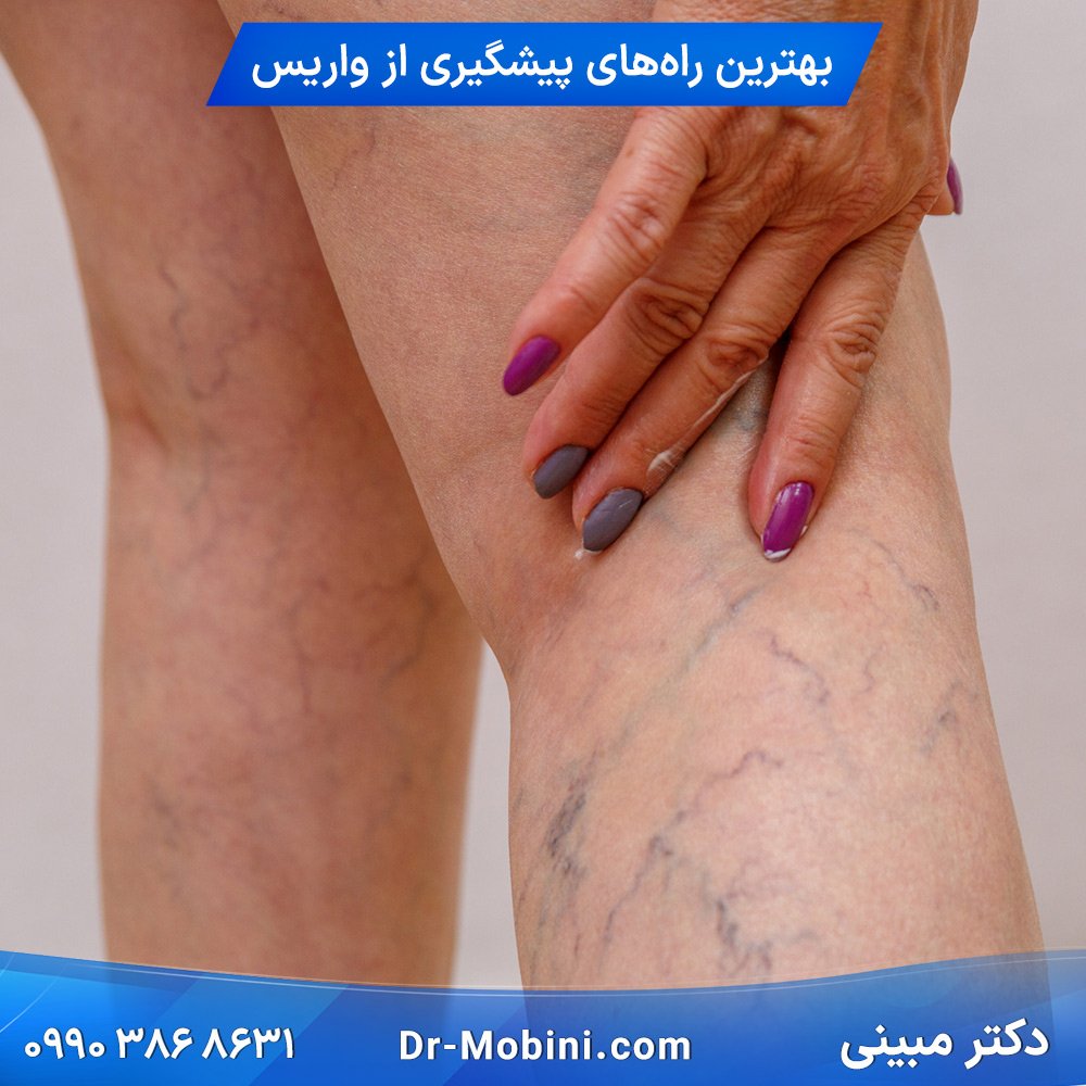 بهترین راه های پیشگیری از واریس چیست؟