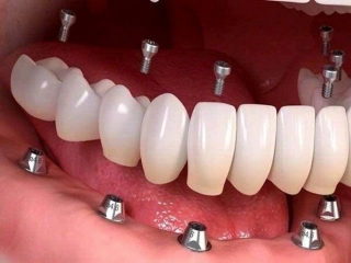 بهترین دندانپزشک ایمپلنت دندان در تهران
