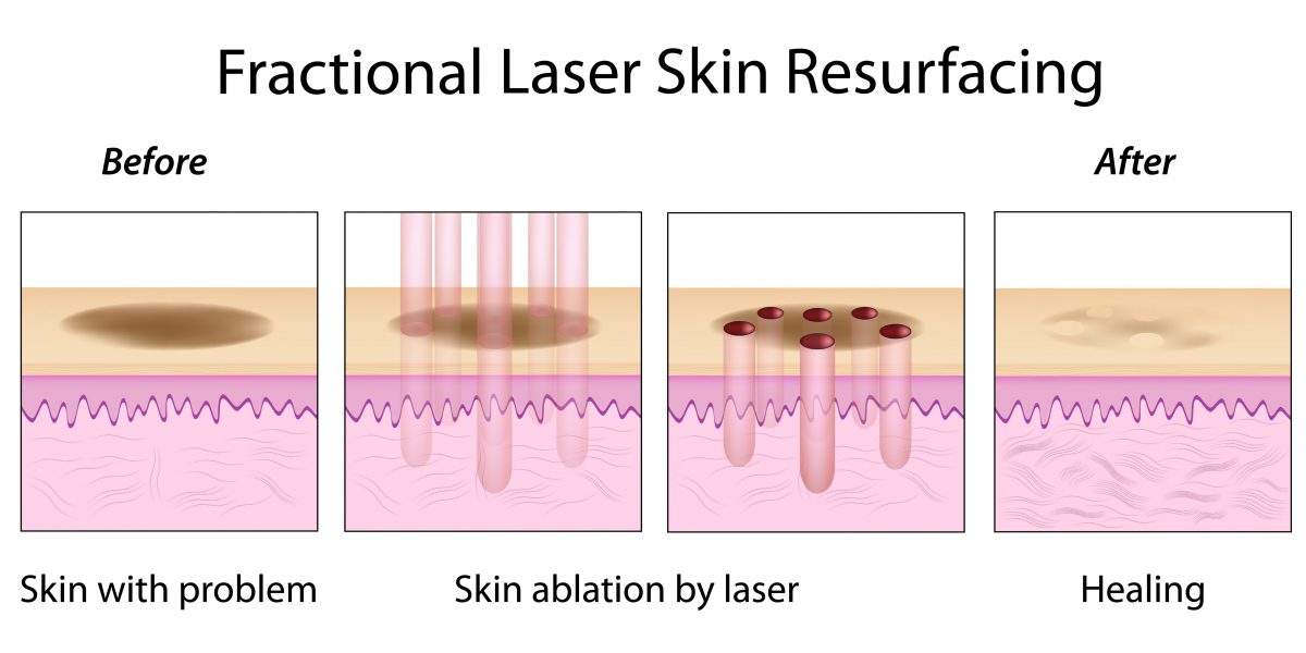 نحوه تأثیرگذاری لیزر فراکشنال Co2 بر روی پوست 