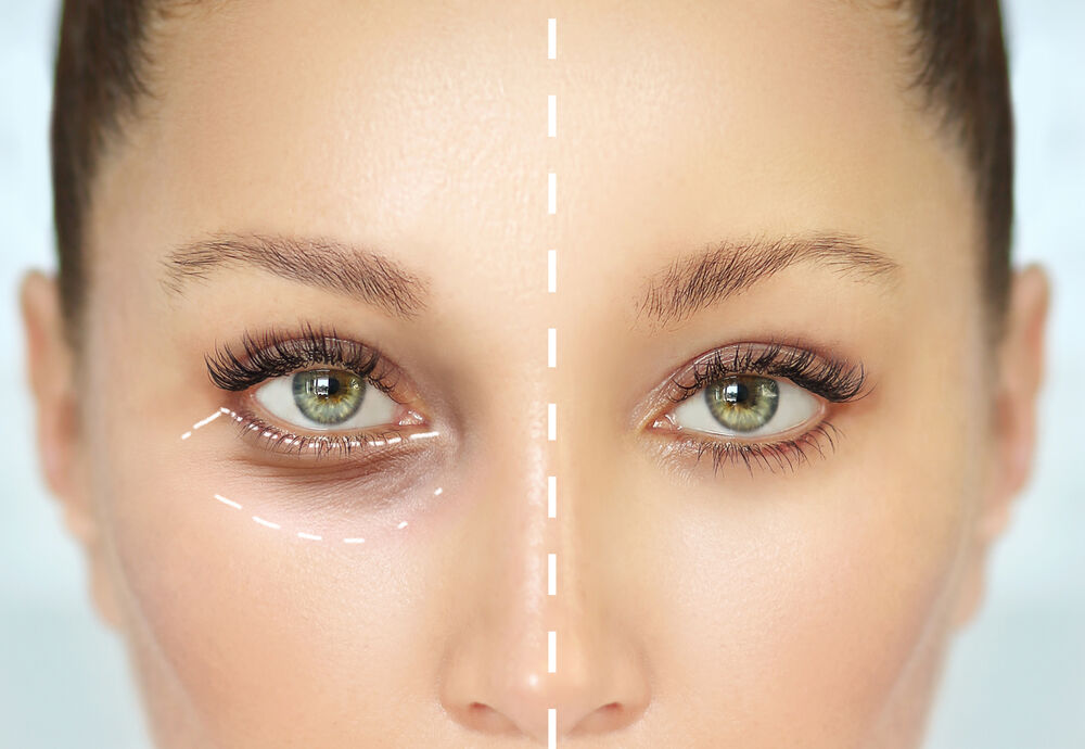 بلفاروپلاستی یا جراحی پلک بلفاروپلاستی، راه حلی برای افتادگی پلک و پف زیر چشم