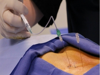 راهکارهای ساده برای درمان فوری درد گردن و جراحی بسته دیسک کمر