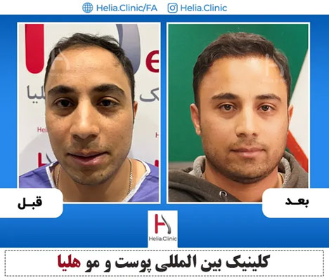 آخرین اخبار از درمان طاسی