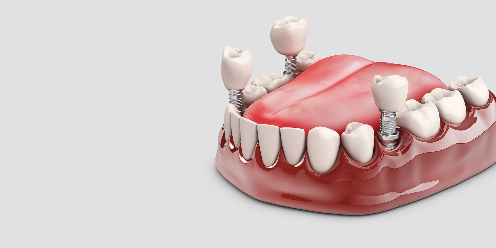 چرا ایمپلنت دیجیتال بهترین روش برای جایگزینی دندان است؟ چرا ایمپلنت دیجیتال بهترین روش برای جایگزینی دندان است؟