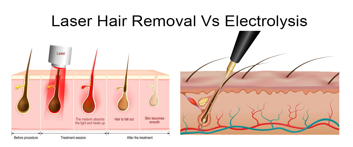 تفاوت فناوری لیزر موهای زائد و الکترولیز