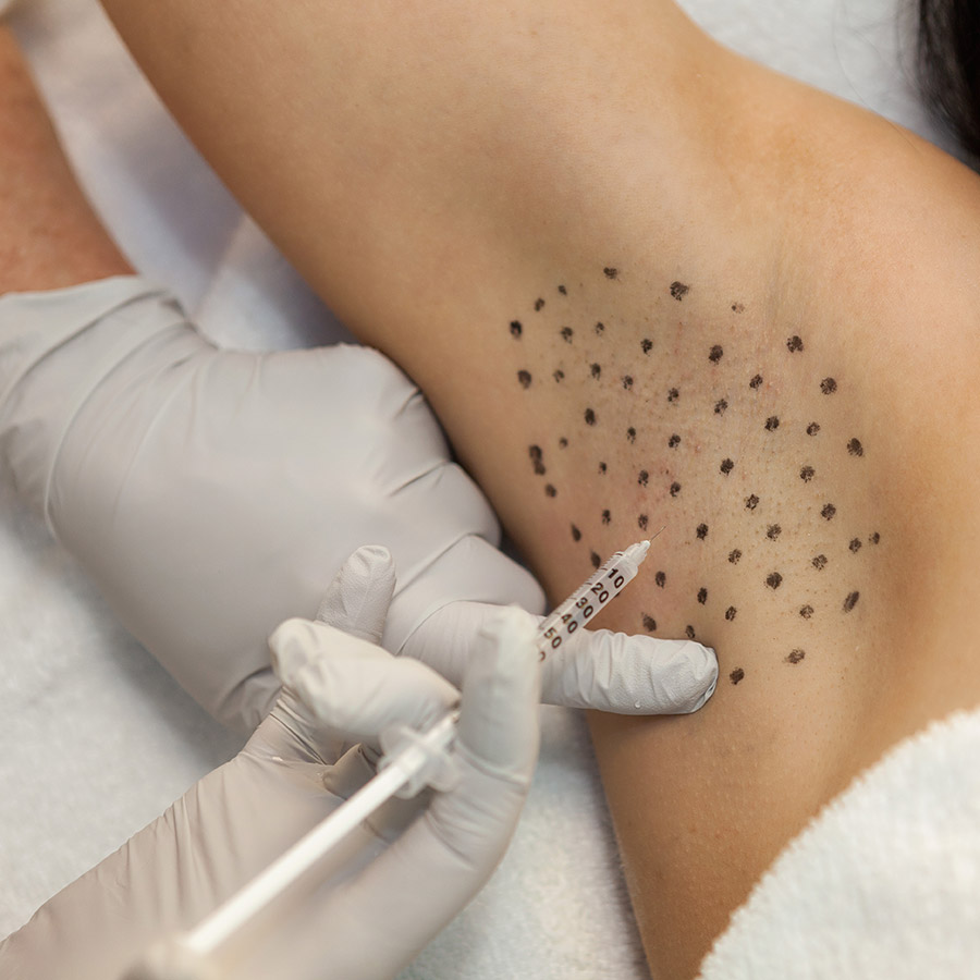 تزریق بوتاکس برای تعریق تزریق بوتاکس برای تعریق