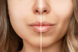 بوکال فت باعث پیری می شود؟