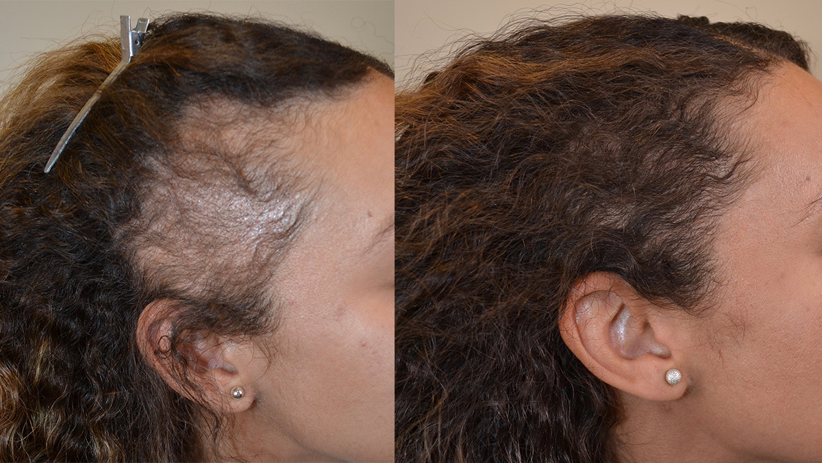 نتایج کاشت مو طبیعی در زنان