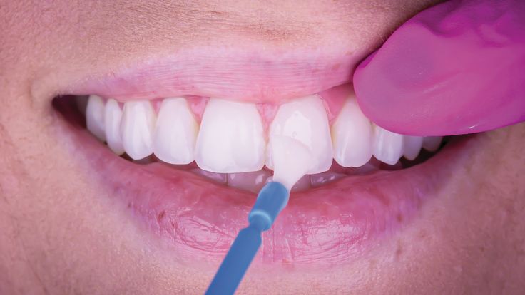 اثرات سودمند فلوراید برای سلامتی دندان‌ها