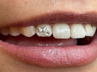 کاشت نگین روی دندان مضر است؟