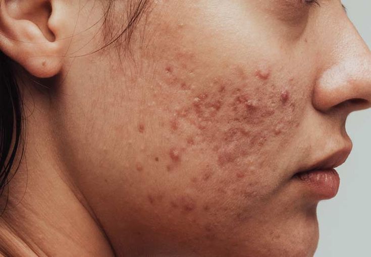 نکات آرایشی برای صورت های آکنه دار