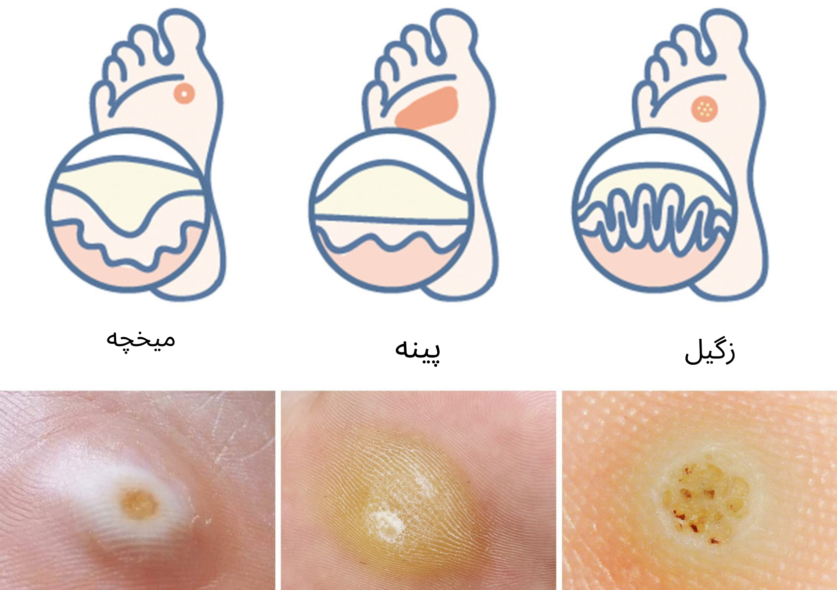 ظاهر میخچه و زگیل