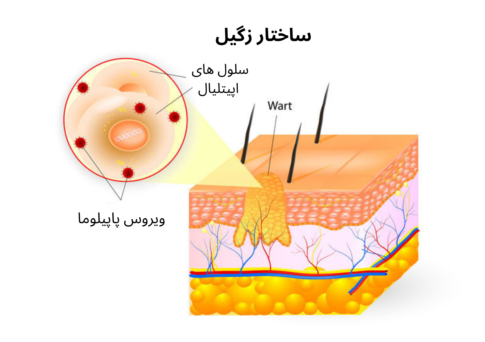 ساختار زگیل و نحوه تشکیل آن
