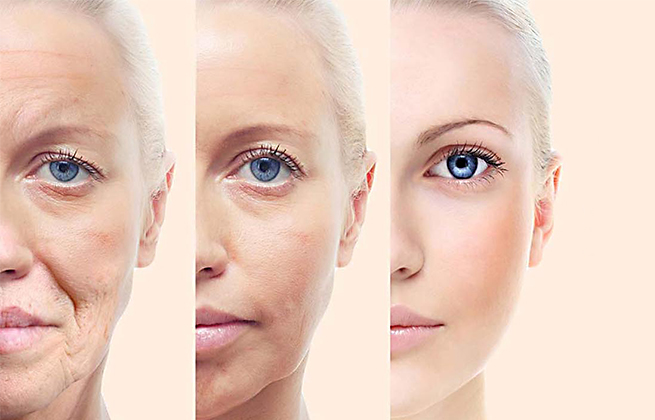 جوانسازی پوست و لیفت صورت