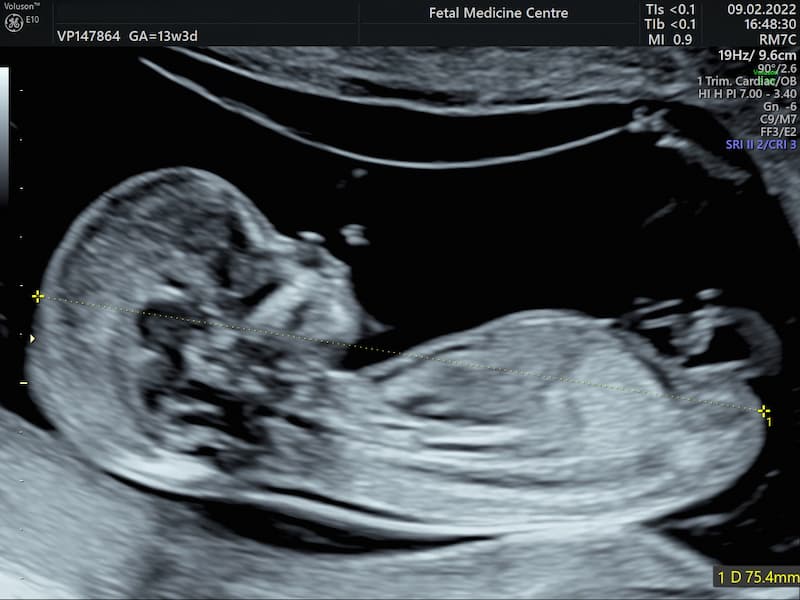 سونوگرافی nt و تعیین جنسیت پسر