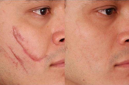 کاهش جای زخم و اسکار با تزریق ژل