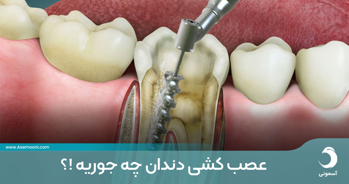 عصب کشی دندان چه جوریه !؟