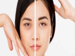 بررسی بهترین روش‌ها برای درمان پف زیر چشم