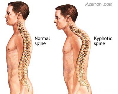 حرکات اصلاحی برای افتادگی شانه ها