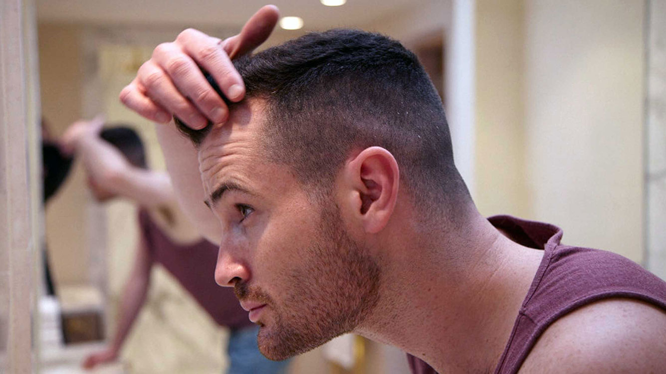 درمان ریزش موی مردان - بخش اول