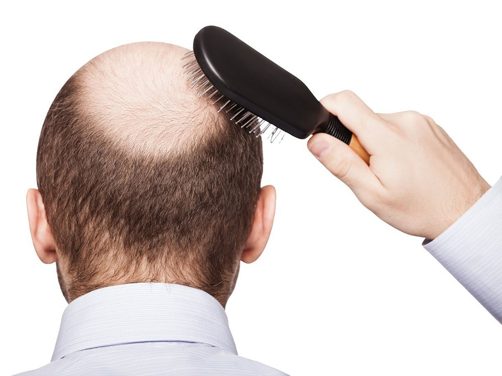 hair-loss-treatment-for-men