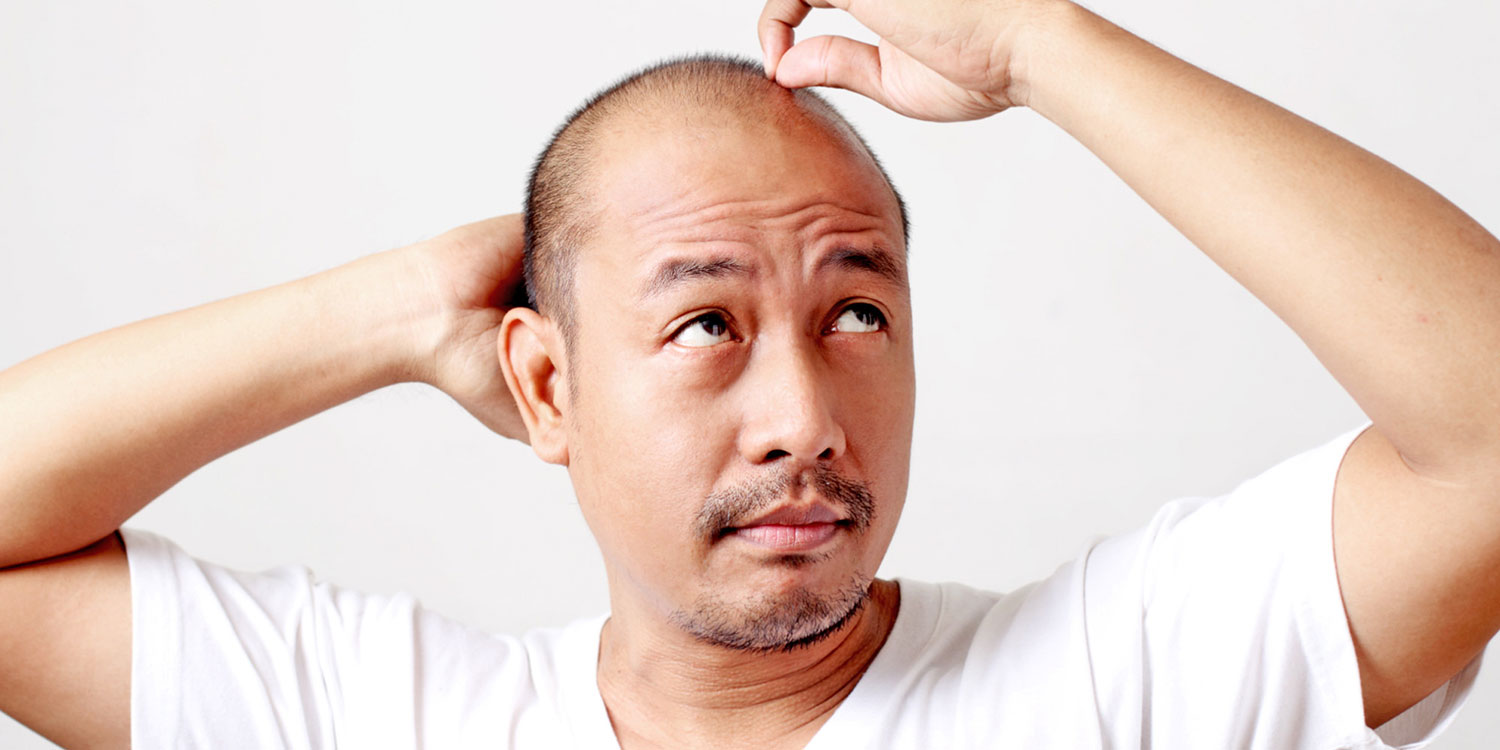 hair-loss-treatment-for-men