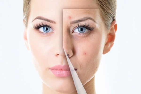 treatment-facial-acne