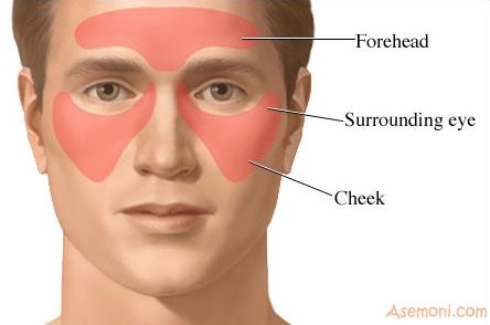 سینوزیت چیست؟