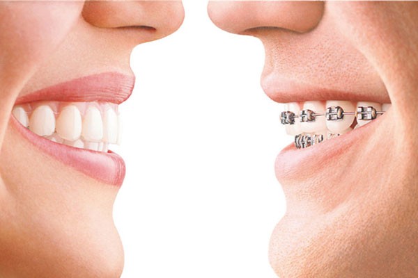 Invisible Orthodontics(3)