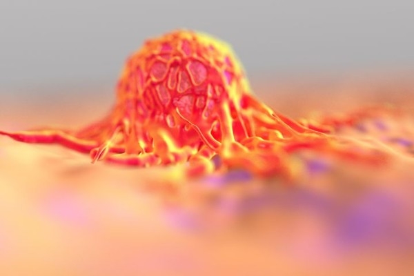 علائم "سرطان سینه" و راه های تشخیص آن