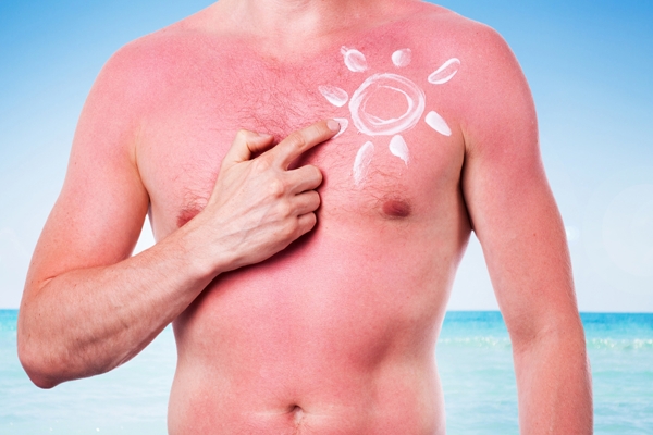Man with a sunburn