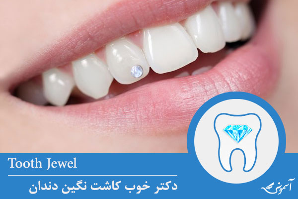 tooth-jewel