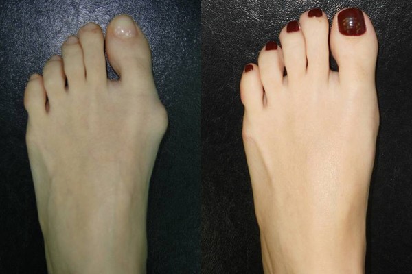Cause and Treatment of Hallux or stand toe(1)
