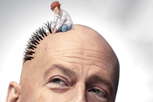 مراقبت های پس از کاشت مو