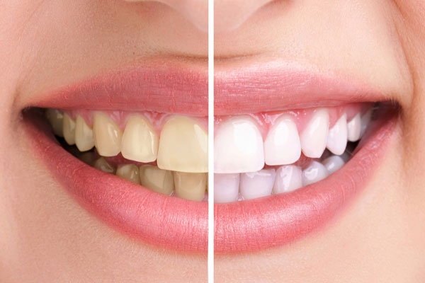 رفع زردی دندان در 5 دقیقه