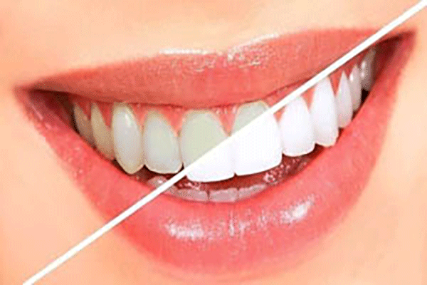 The easiest way to have a beautiful and shiny teeth