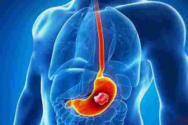 ریفلاکس معده، علل و درمان