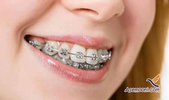 دلیل کج رشد کردن دندان ها چیست ؟