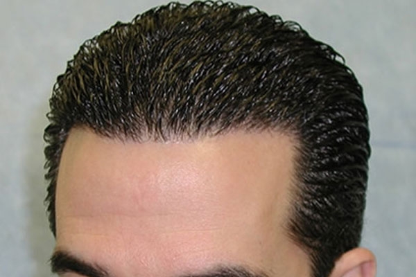 بهترین روش کاشت مو کدام است؟