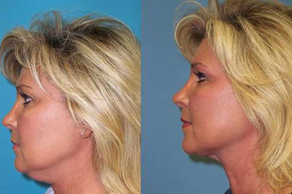 Exercise-proper-double-chin-removal