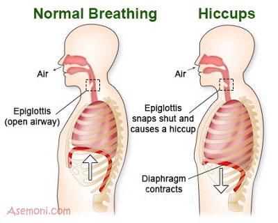 علل بروز سکسکه چیست؟