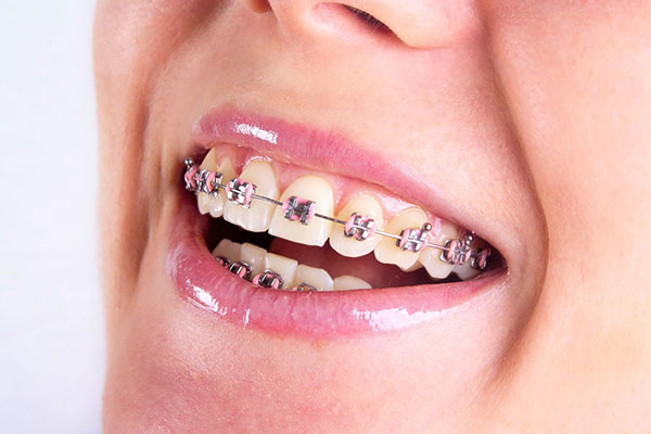 orthodontic1