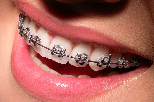orthodontic5