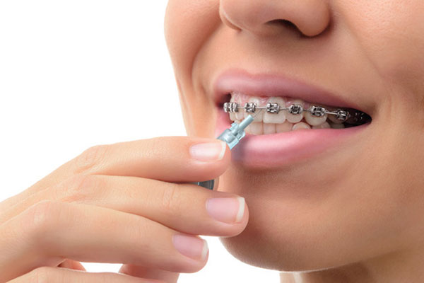 بهداشت و مراقبت از دهان و دندان در زمان ارتودنسی