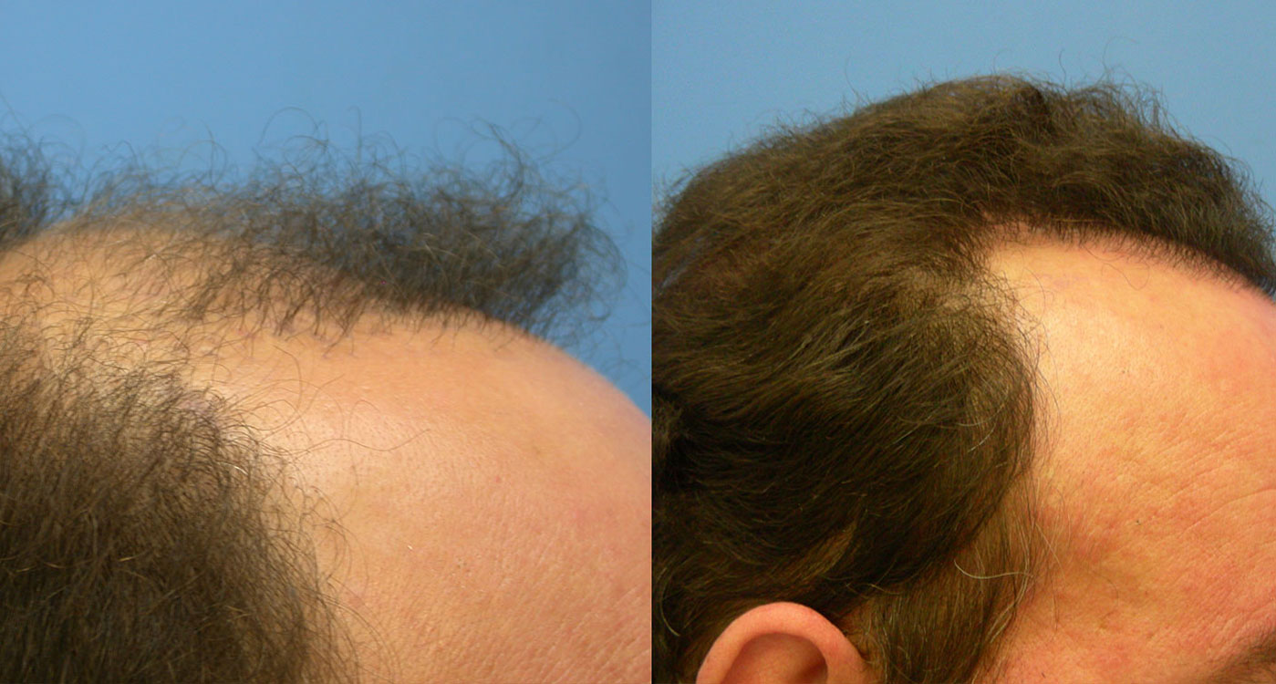 hair-transplant-laser-prp