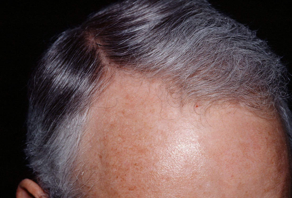 lupus-hair-loss